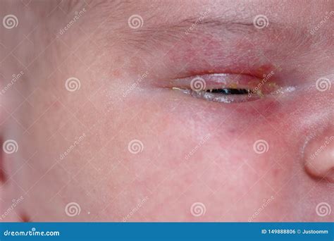 The Purulent Eye Processed by Tetracycline Ointment Conjunctivitis ...