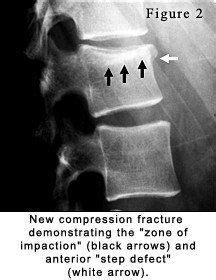 Image result for Compression Fracture Step Defect