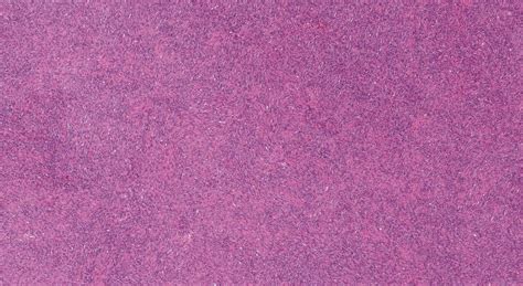 Image result for Dermatofibrosarcoma Protuberans