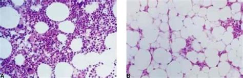 Aplastic anemia – Dentowesome