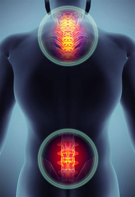 Kuvatulokset haulle cervical radiculopathy