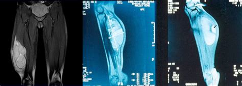 Soft Tissue Sarcoma Cancer Treatment in Chennai