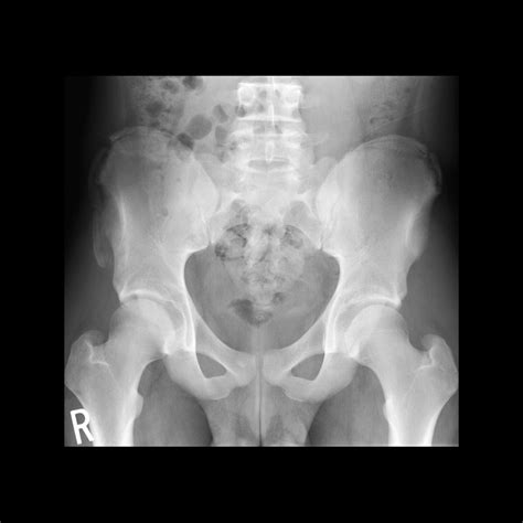 Avulsion Fracture Hip Iliac Crest