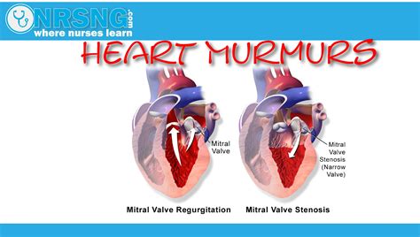 Heart Murmurs | Aortic/Mitral Stenosis, Regurgitation | How to identify ...