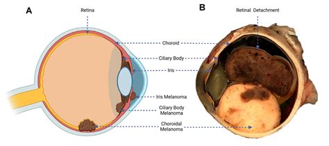 Current Treatment of Uveal Melanoma