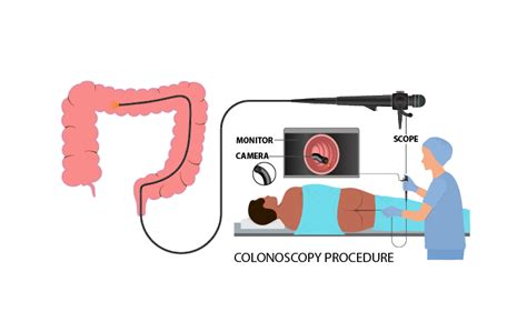Colonoscopy Process 的图像结果