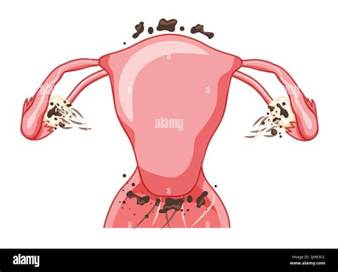 Endometriosis 3 stage Female reproductive system Front view. Human ...