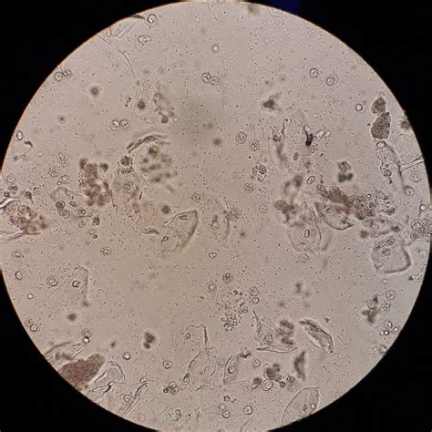 Microscopic Urinalysis Wbc And Rbc Bacteria