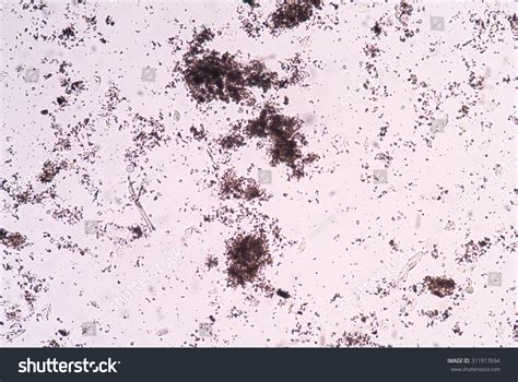 Amorphous Crystals In Urine Normal Range at Jessica Owens blog