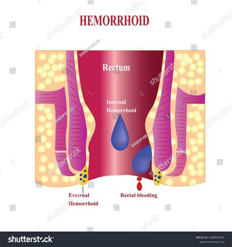 Bleeding External Hemorrhoids