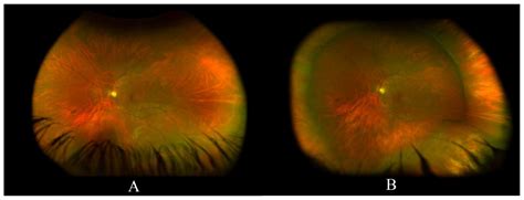 Scleral Buckling: A Review of Clinical Aspects and Current Concepts