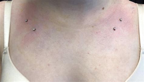 Clavicle Piercing Scars