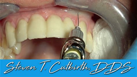 Infiltration Anesthesia Dental Lower 的图像结果