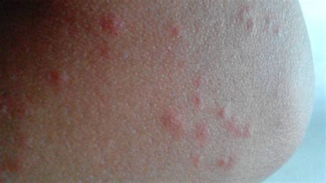 皮肤出现丘疹、红斑、小水泡，还剧烈瘙痒是怎么回事？_患者