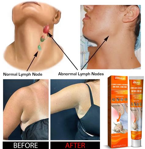 Swollen Lymph Nodes Behind Ear