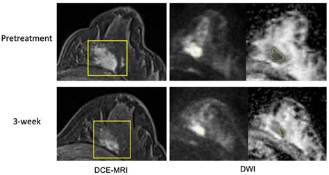 Pathological Complete Response