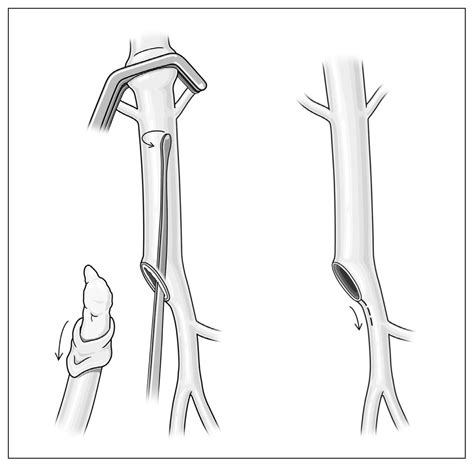 Feasibility of patchless proximal profundoplasty and common femoral endarterectomy | CJS