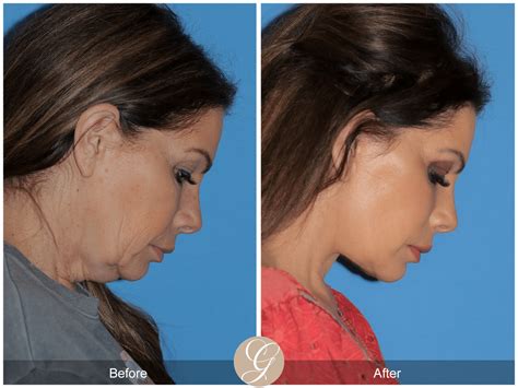 Face Lift Deep Plane at Sergio Hasting blog