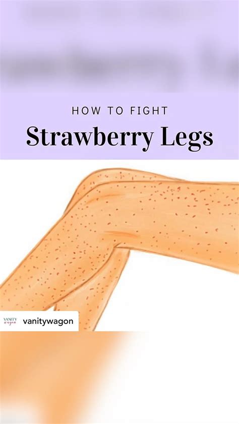 How to get rid of strawberry legs in 5 easy steps – Artofit