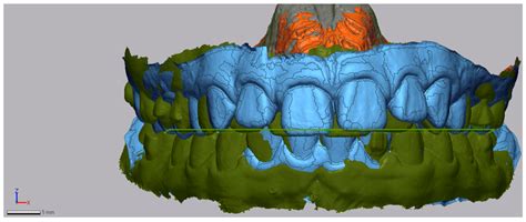 Retrospective Evaluation of Invisalign® Mandibular Advancement in ...