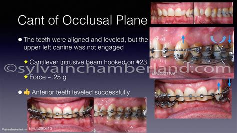 Occlusal plane inclination - Dr. Sylvain Chamberland, Orthodontist