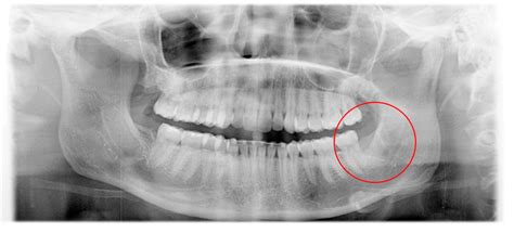 Osteomyelitis Jaw After Wisdom Teeth Extraction