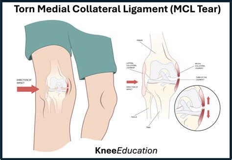 Medial Collateral Ligament Tear -MCL Tear - Knee Education