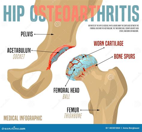 Hip Osteoarthritis Infographic Cartoon Vector | CartoonDealer.com ...