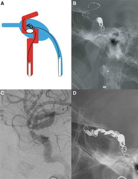 Carotid-Cavernous Fistula Treatment in Vascular Ehlers-Danlos Syndrome: A Case Report and Review ...