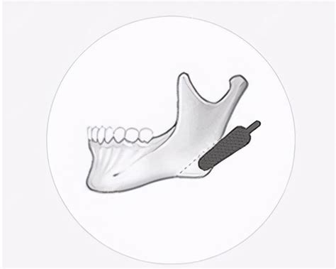 下颌角磨骨术恢复期的详细经历及术后感受，大公开！_千颜网