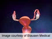 Image result for Intraperitoneal Injection Ovarian Cancer