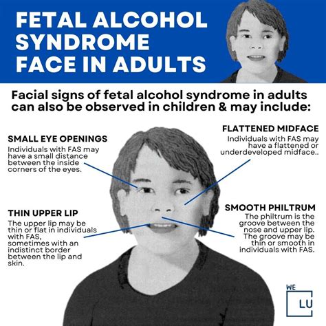 Fetal Alcohol Spectrum Disorder (FASD) : Fetal Alcohol Spectrum Disorder (FASD)