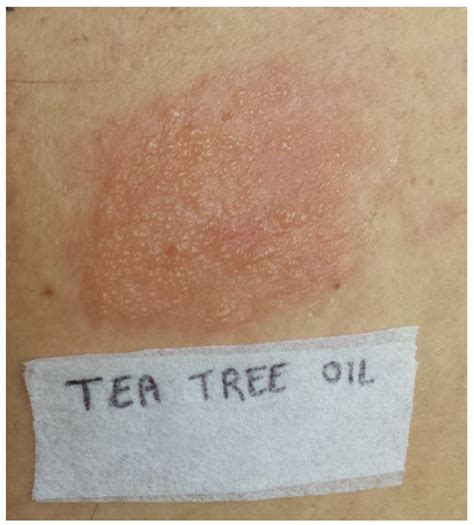 Spreading Allergic Contact Dermatitis to Tea Tree Oil in an Over-the-Counter Product Applied on ...