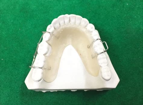 S-clasp with Apron Spring: A Single Tooth Crossbite Correction in ...