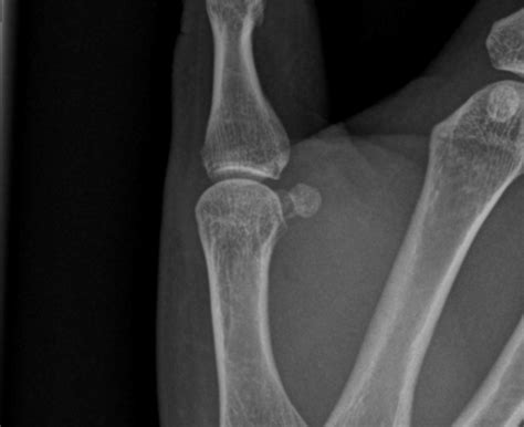 Sesamoid Fracture Definition , Anatomy, Sesamoid Bones – XPEMYE