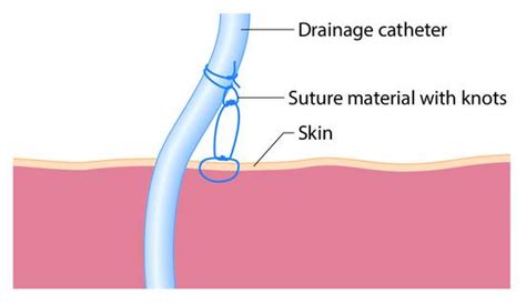 Carbuncle Drainage Procedure 的图像结果