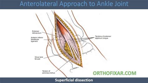 Image result for Ankle Anterolateral Approach Injection