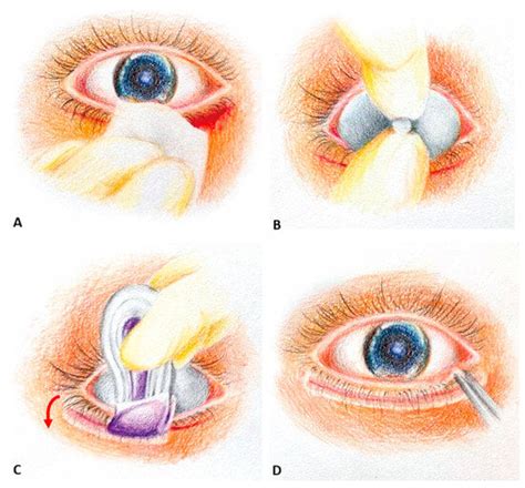 A Comparison between 2-Octyl Cyanoacrylate and Conventional Suturing ...