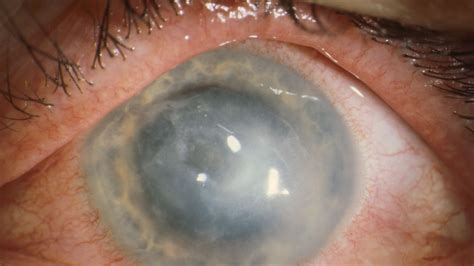 Acanthamoeba Keratitis