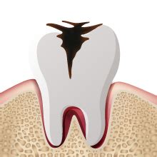 Buy GLODENT - Natural Teeth Whitening Toothpaste 70gms by GPL (Set of 2 ...