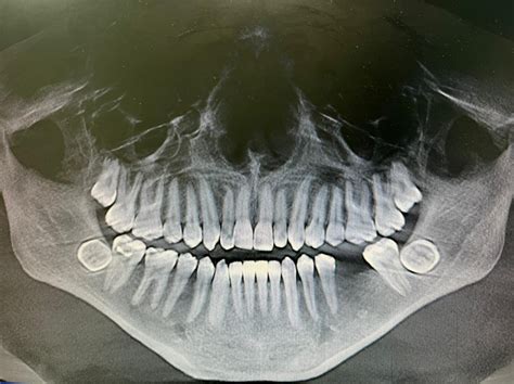 Upper 3rd molar extraction – NIR dental