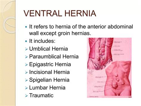 VENTRAL HERNIA.pptx | Pregnancy | Reproductive Health