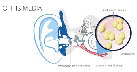 Otitis media | Symptoms & Treatment | hear.com India
