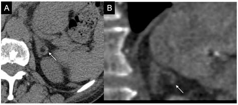 Adrenal Mass Evaluation: Suspicious Radiological Signs of Malignancy