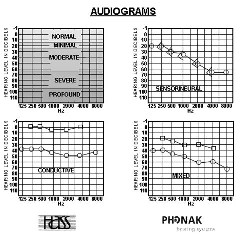 Audiogram Types and examples 的图像结果