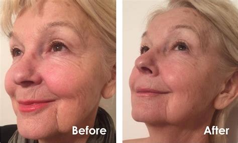 Myolift Ultra | Professional Microcurrent Machine – 7ewellness