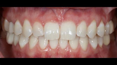 Image result for Inlab Splint Design