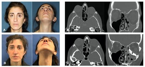 Patient Specific Implants for Orbital Reconstruction in the Treatment of Silent Sinus Syndrome ...