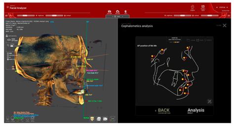 Predictable Full Digital Workflow Using Stackable Surgical Templates ...