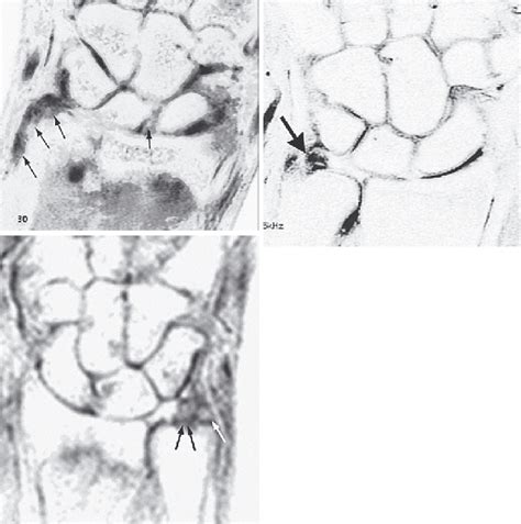 Download Triangular Fibrocartilage Tear Syndrome - Medical Imaging PNG Image with No Background ...